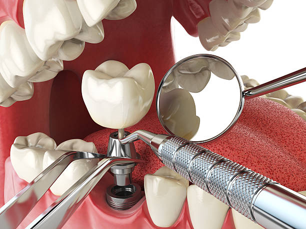 Best Broken or Cracked Tooth Emergency Dentist in Yuma, CO